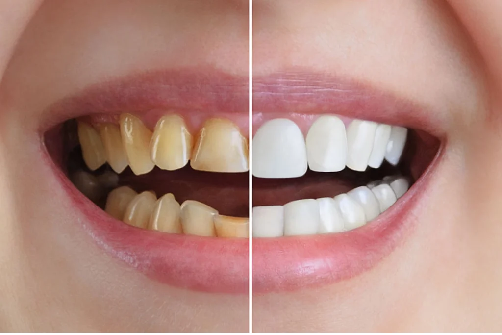 carillas dentales antes y despues