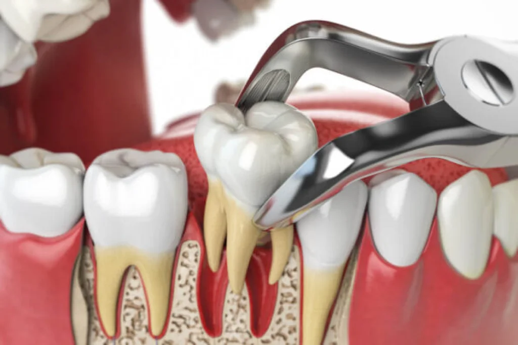 extraccion dental de muela